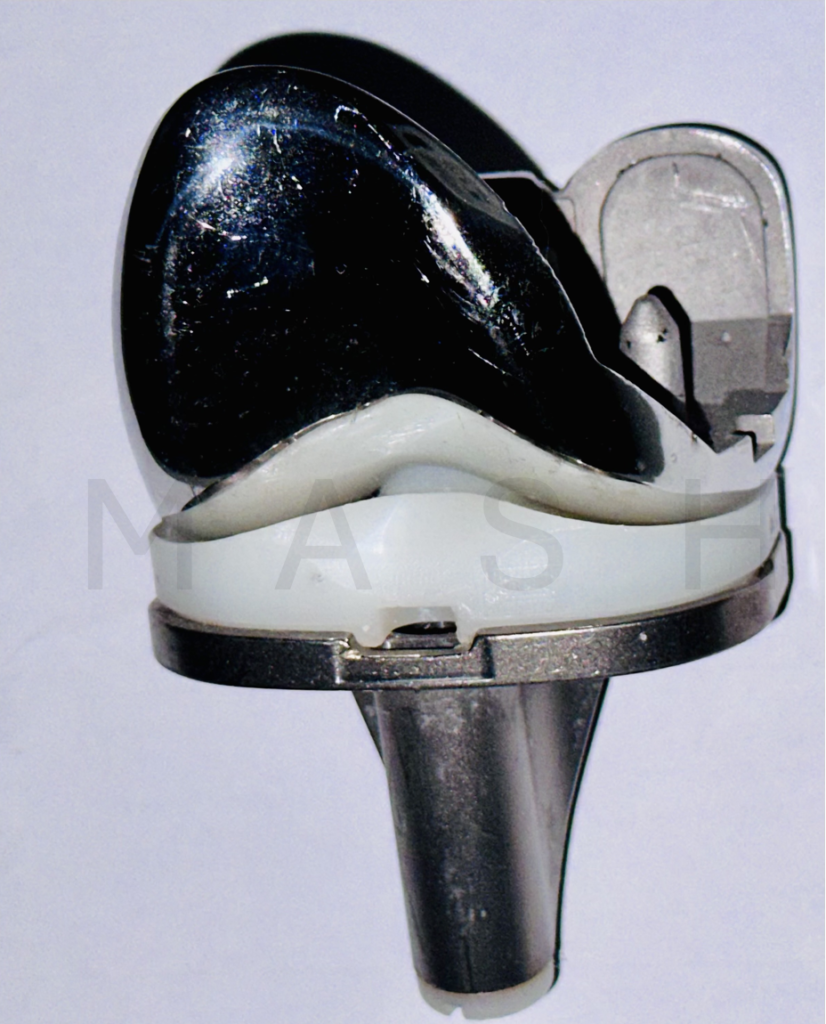 Figure: Total knee replacement (metal components with a polymer)