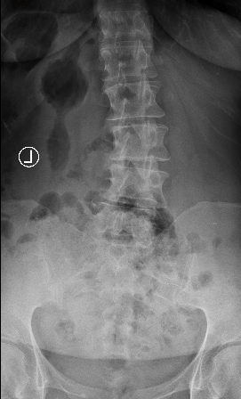 X-ray showing scoliosis affecting the lower back (lumbar scoliosis)