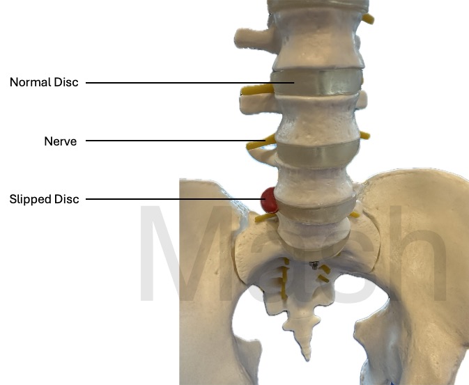 Figure showing a slipped disc in the low back (lumbar spine)