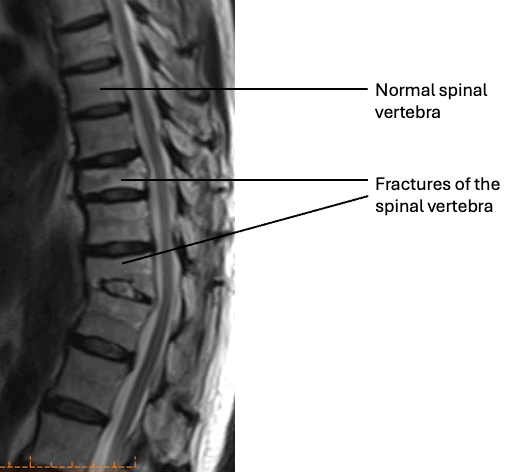 Figure showing normal shaped vertebra and spine fractures