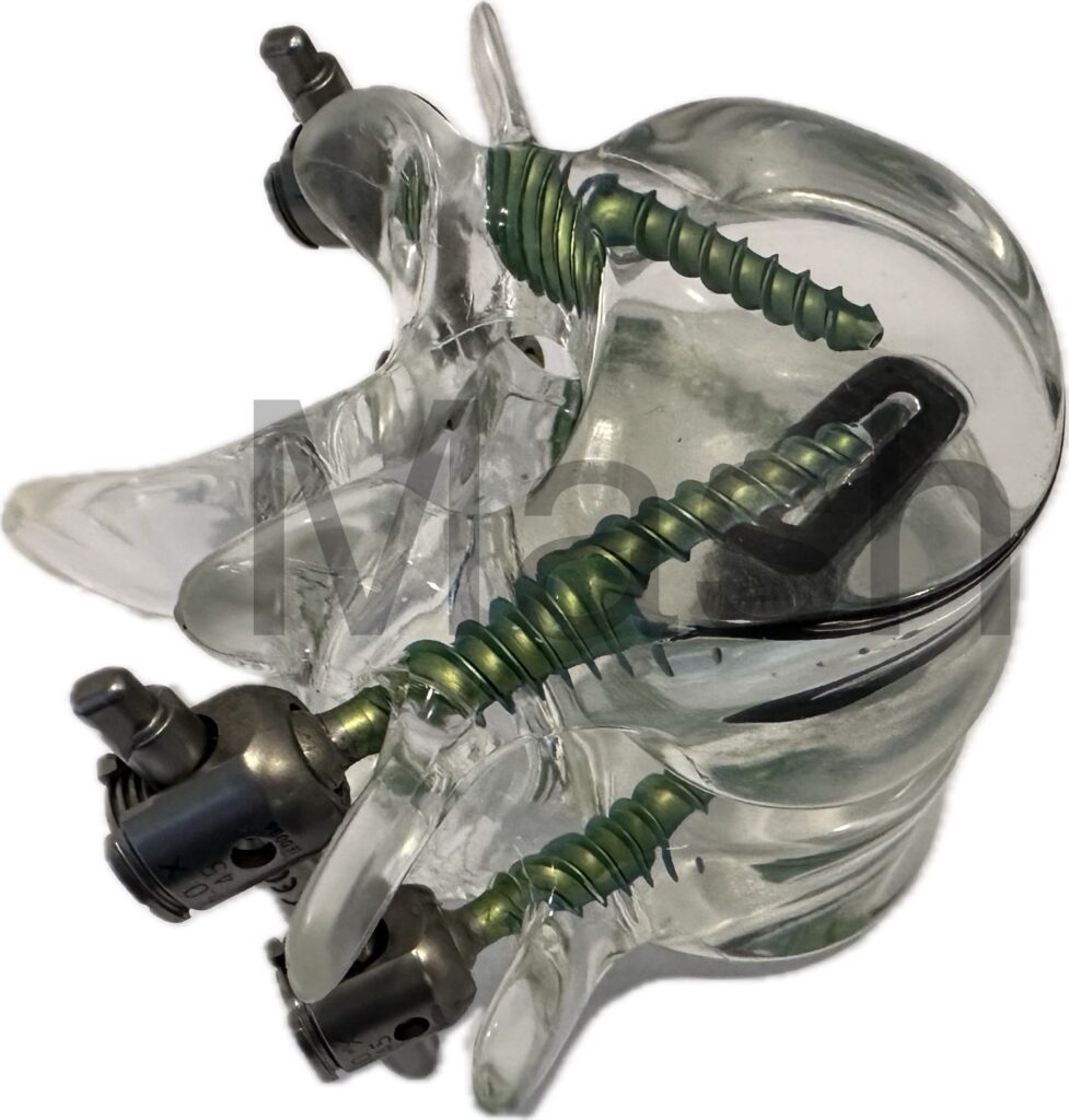 Picture of a transforaminal lumbar interbody fusion (TLIF)