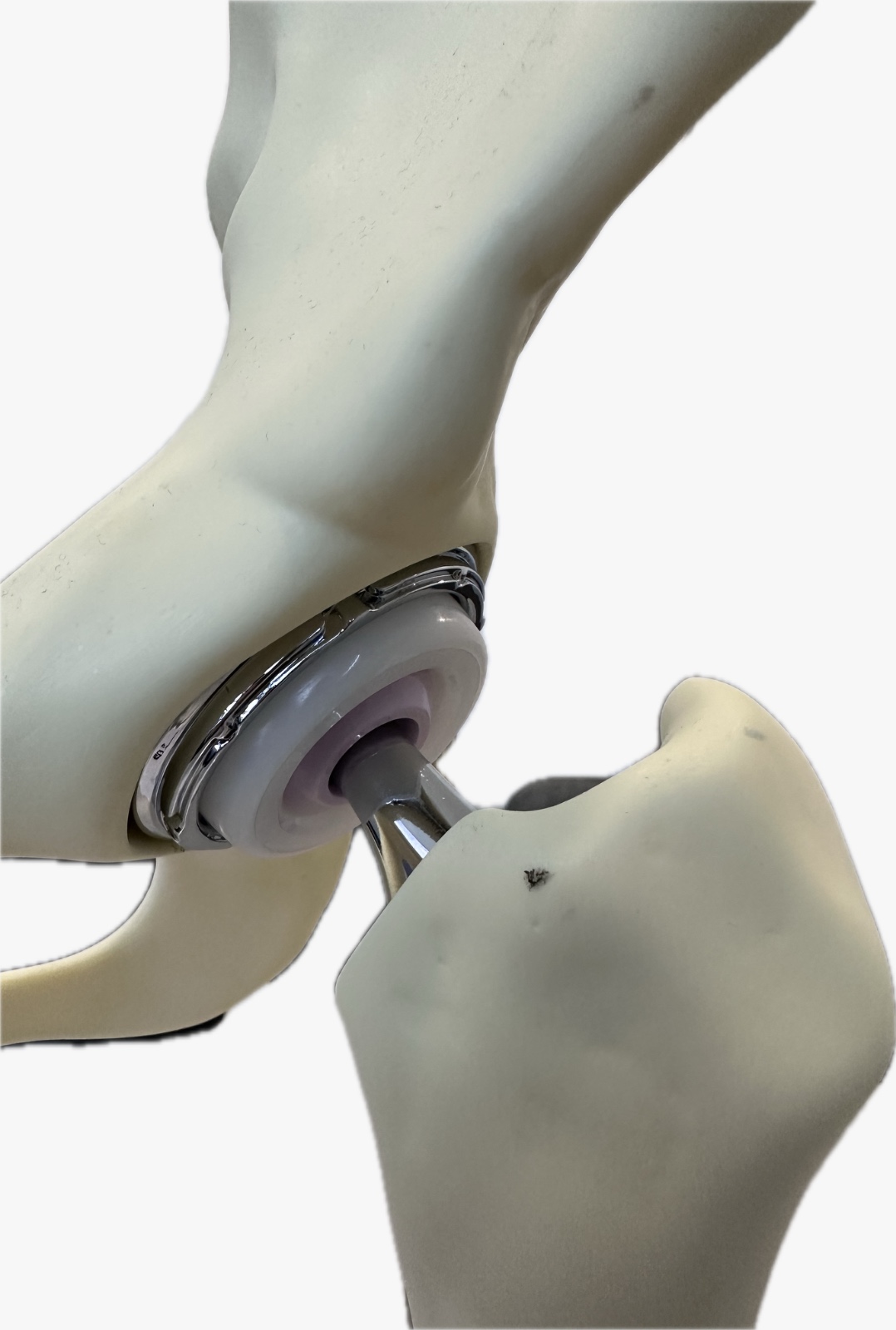 Picture showing a total hip replacement (commonly used for osteoarthritis of the hip and end-stage avascular necrosis of the hip)