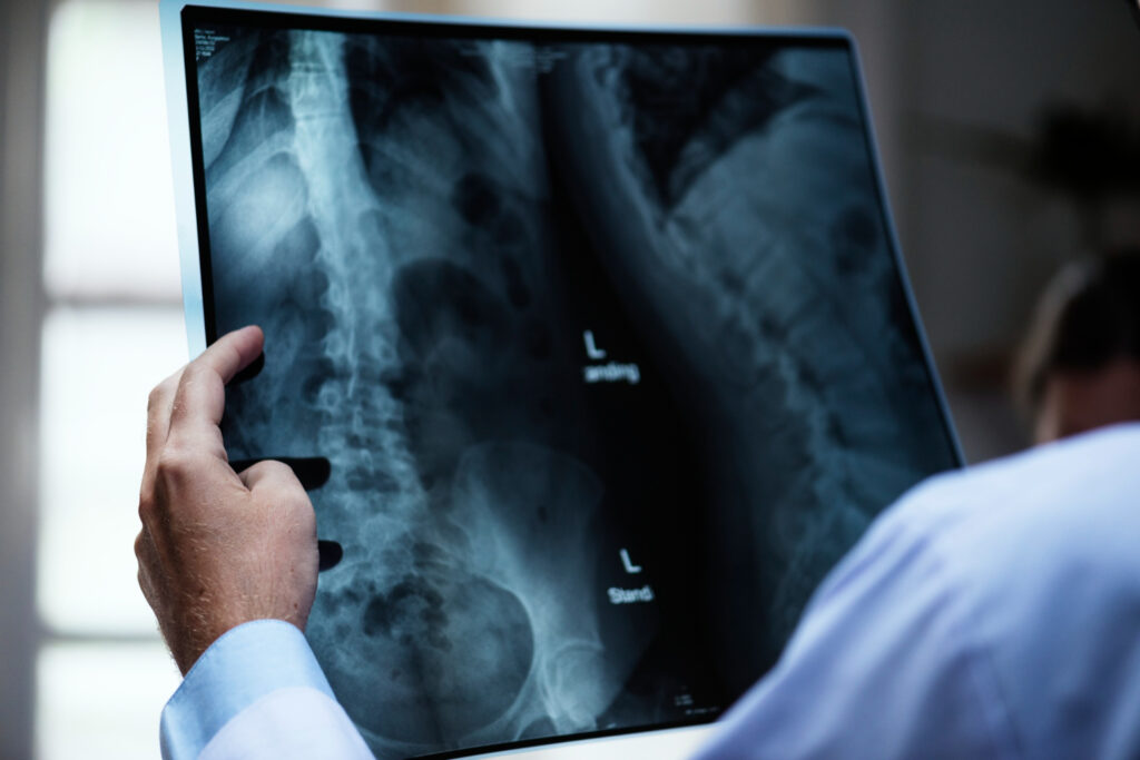 Medical professional holding an X-ray film of the lower spine and pelvis, with a left marker visible on the image.
